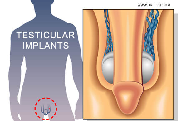 Testicular Implants | Prostheses